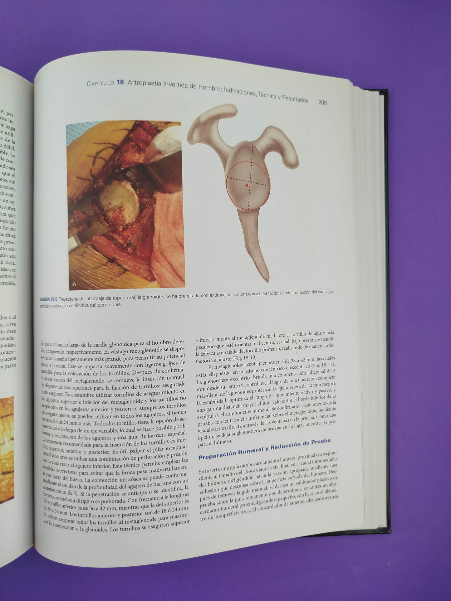 Artritis y artroplastia del hombro