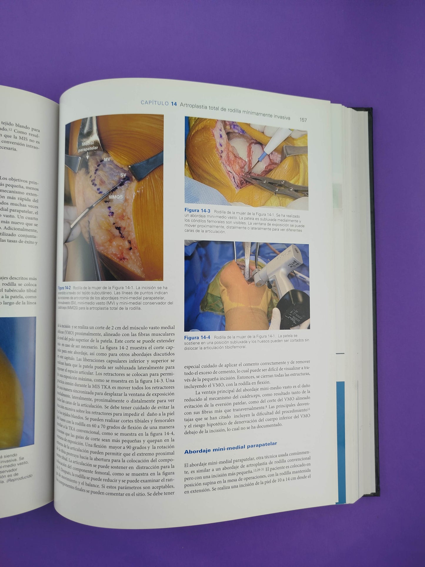 Artritis y artroplastia rodilla