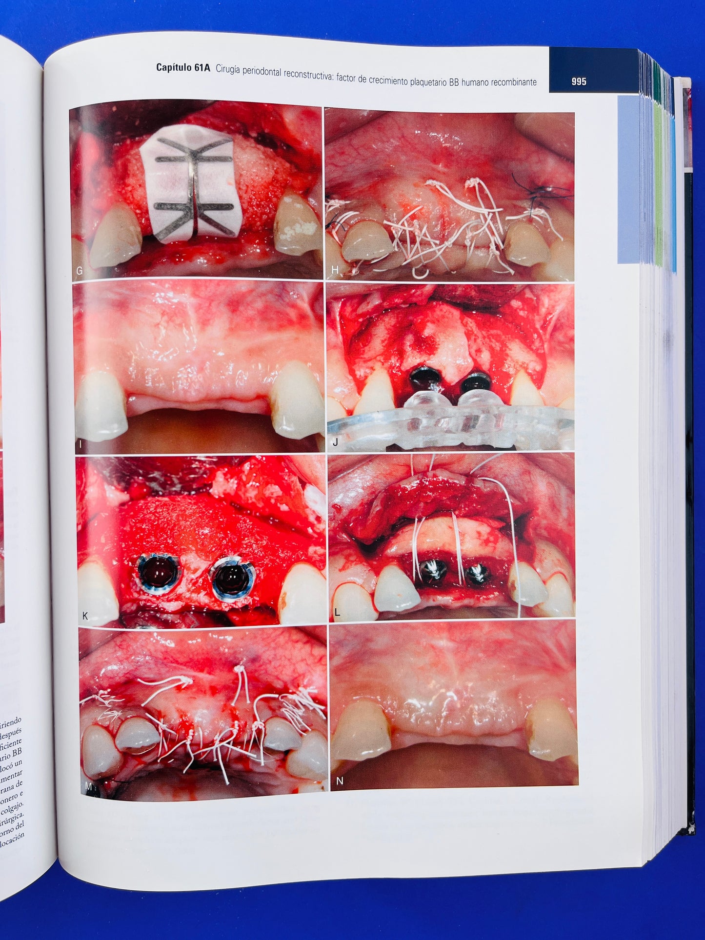 Periodontología Clínica de Carranza onceava edición