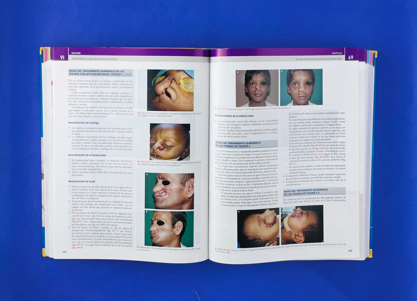 Cirugía Oral y Maxilofacial atlas de procedimientos y técnicas quirúrgicas