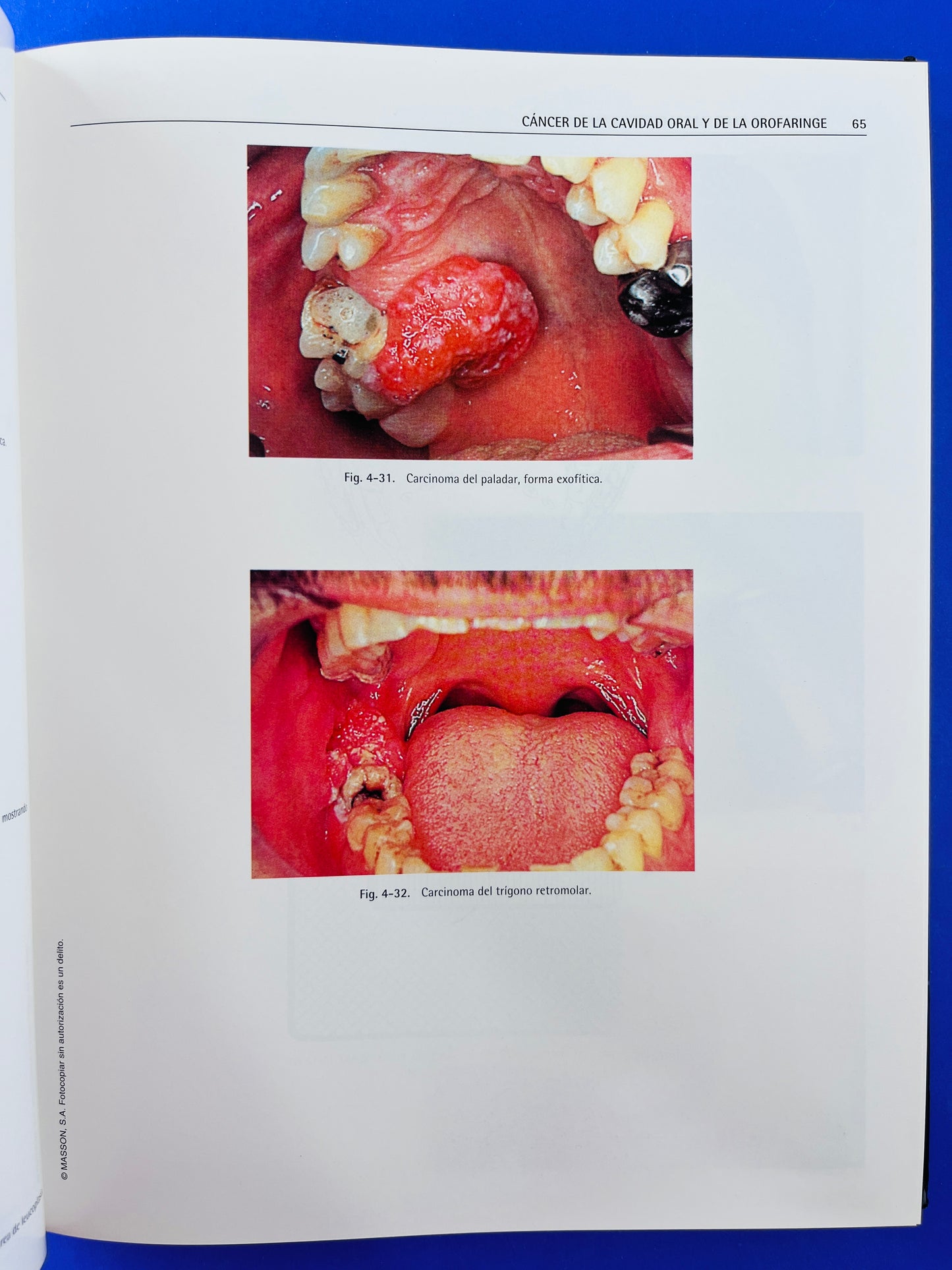Tumores de cara, boca, cabeza y cuello atlas clínico segunda edición