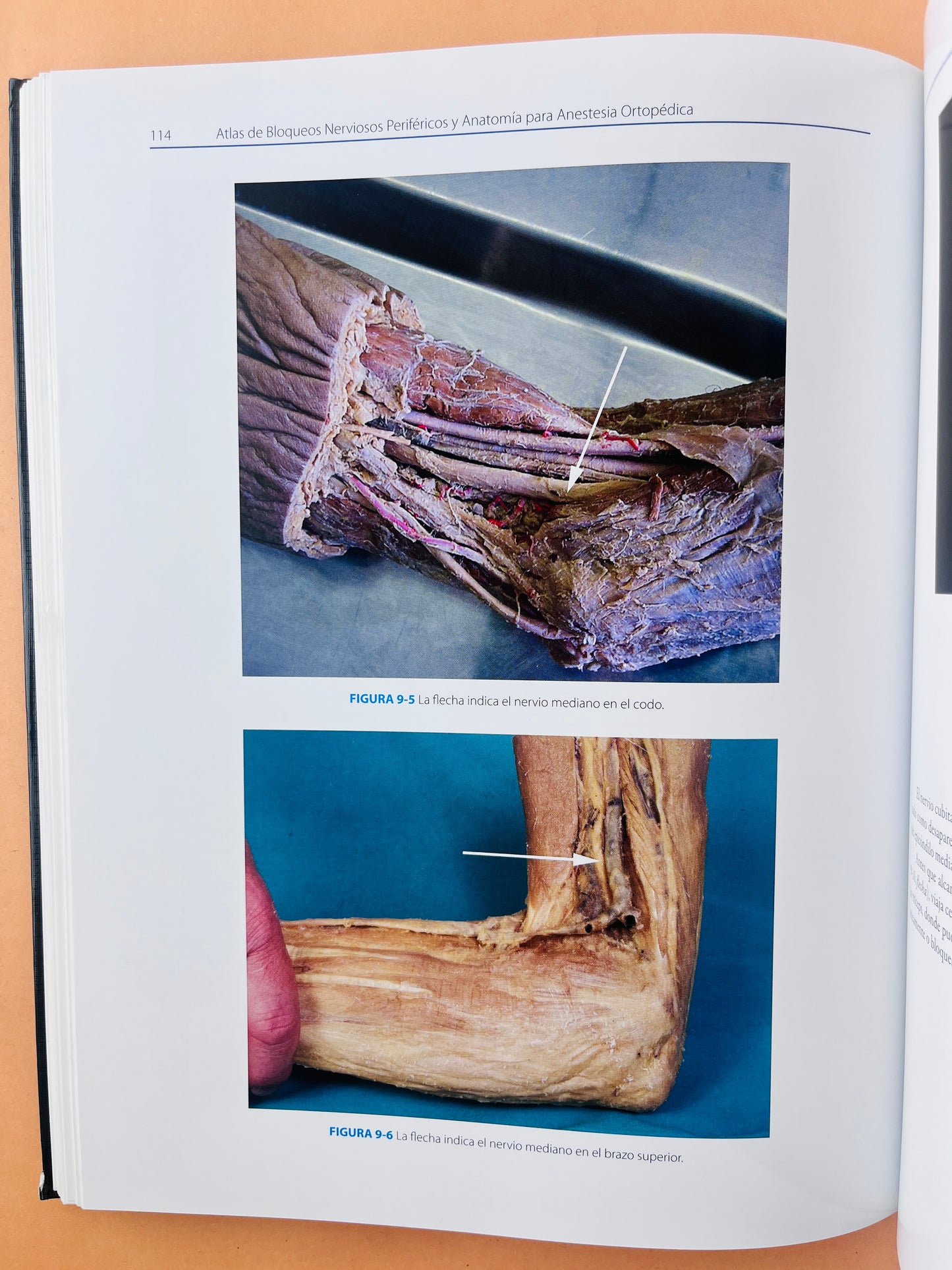 Atlas de Bloqueos Nerviosos Periféricos y Anatomía para Anestesia Ortopédica