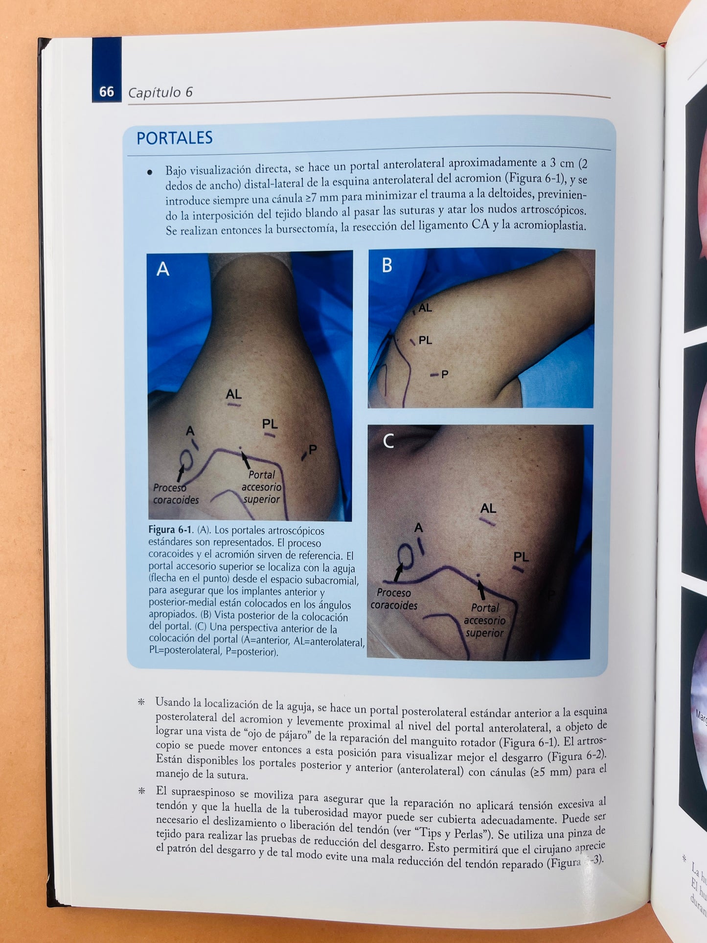 Tips y Perlas Artroscópicas de hombro paso a paso