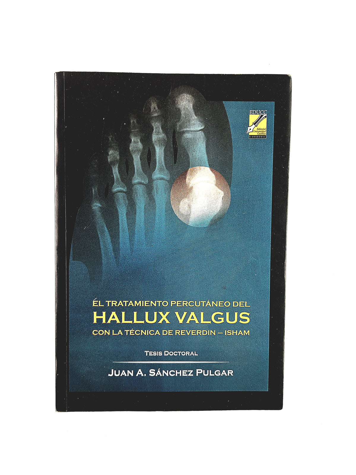 El tratamiento percutáneo del Hallux Valgus con la técnica de Reverdin Isham by Juan A. Sánchez Pulgar