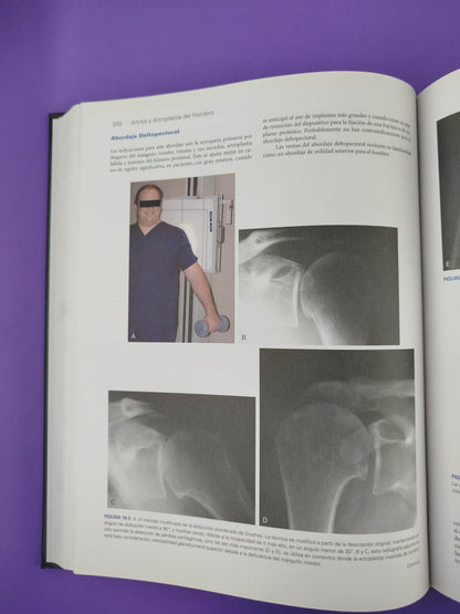 Artritis y artroplastia del hombro