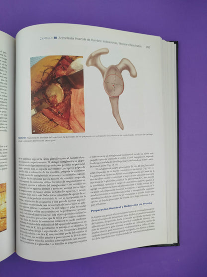 Artritis y artroplastia del hombro