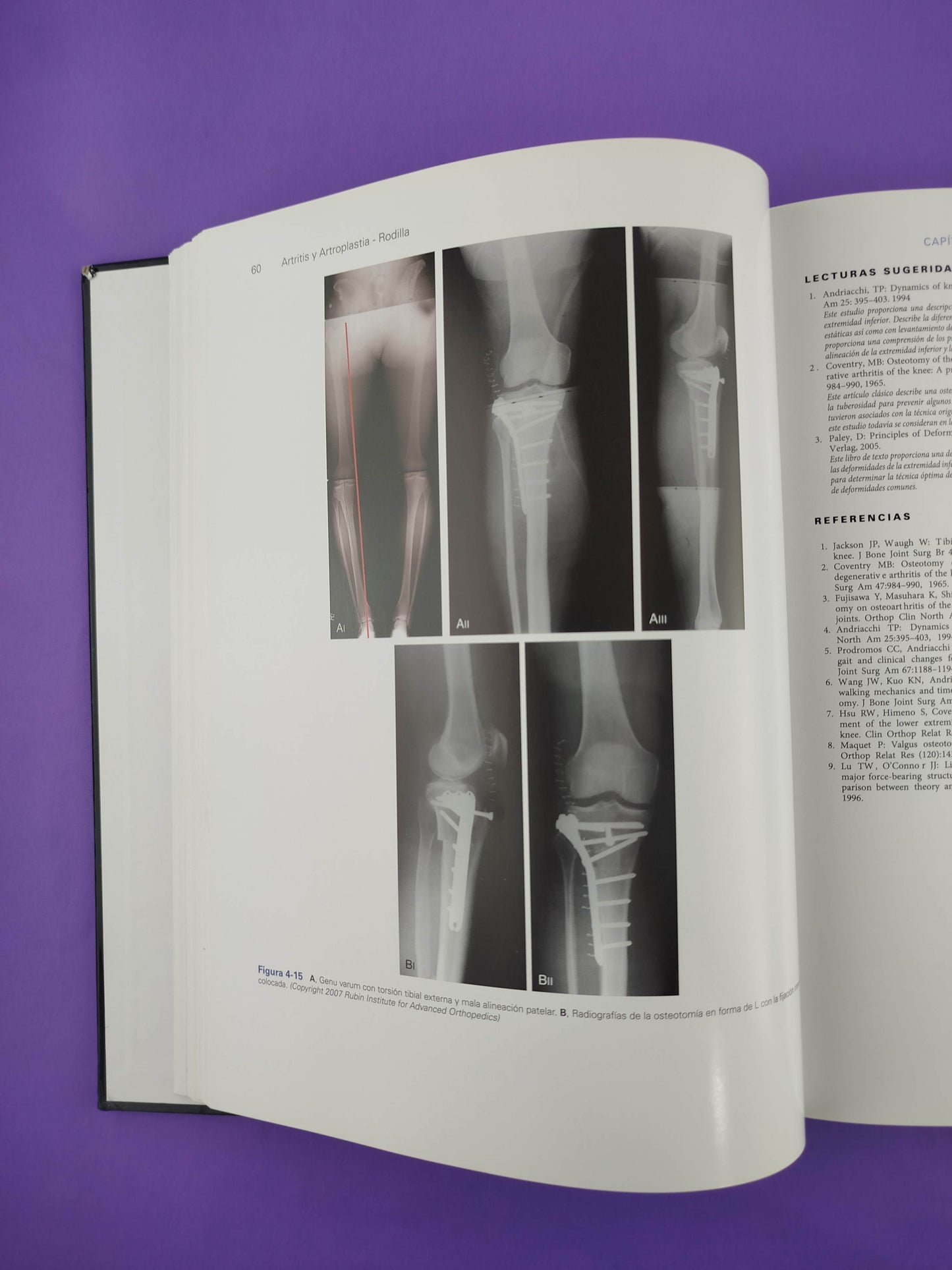 Artritis y artroplastia rodilla