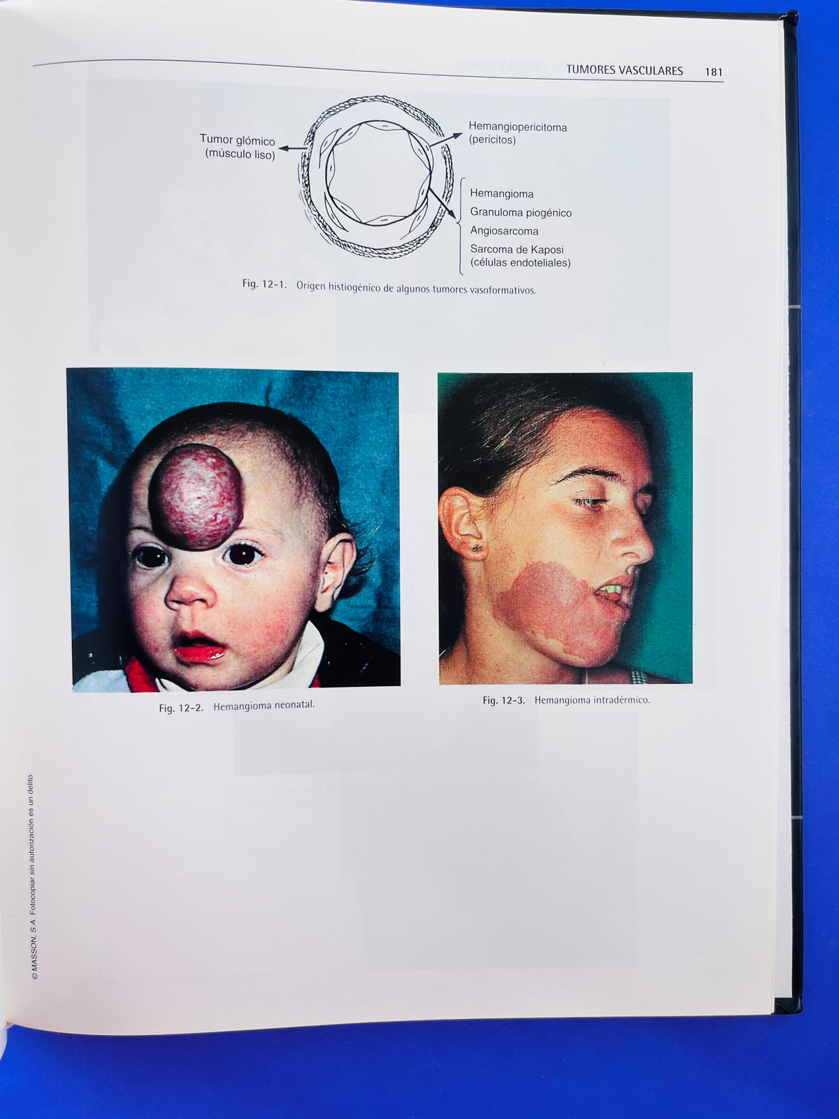 Tumores de cara, boca, cabeza y cuello atlas clínico segunda edición by Guillermo Raspall