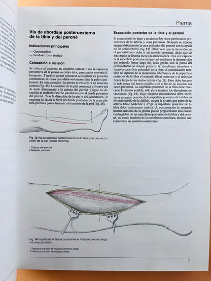 Cirugía Ortopédica Pie y Tobillo con técnicas microquirúrgicas generales