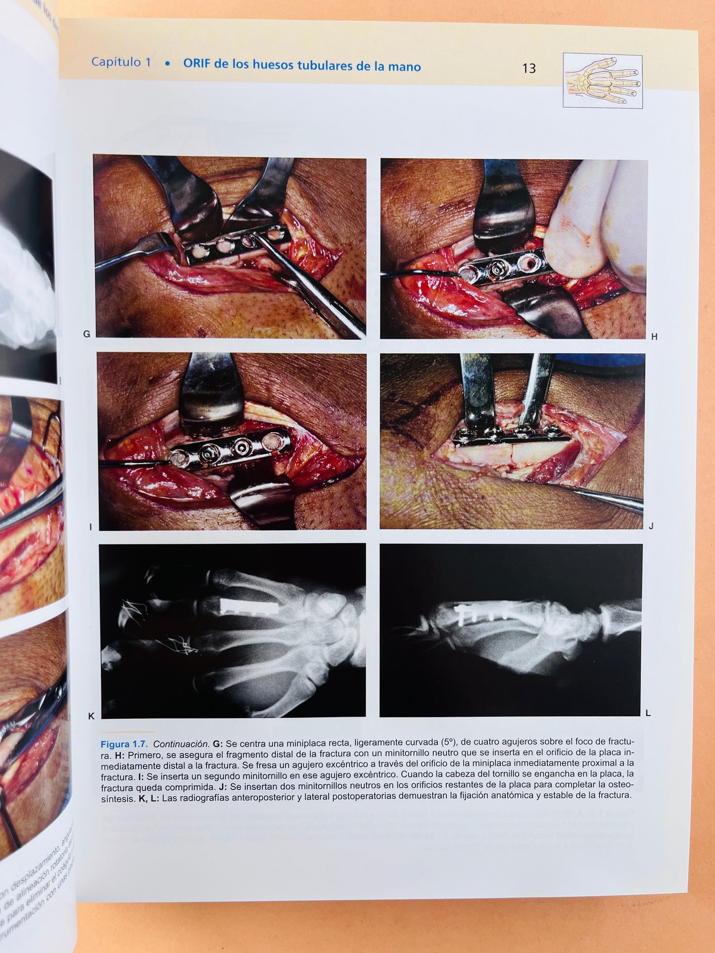 Strickland & Graham Técnicas en Cirugía Ortopédica Mano