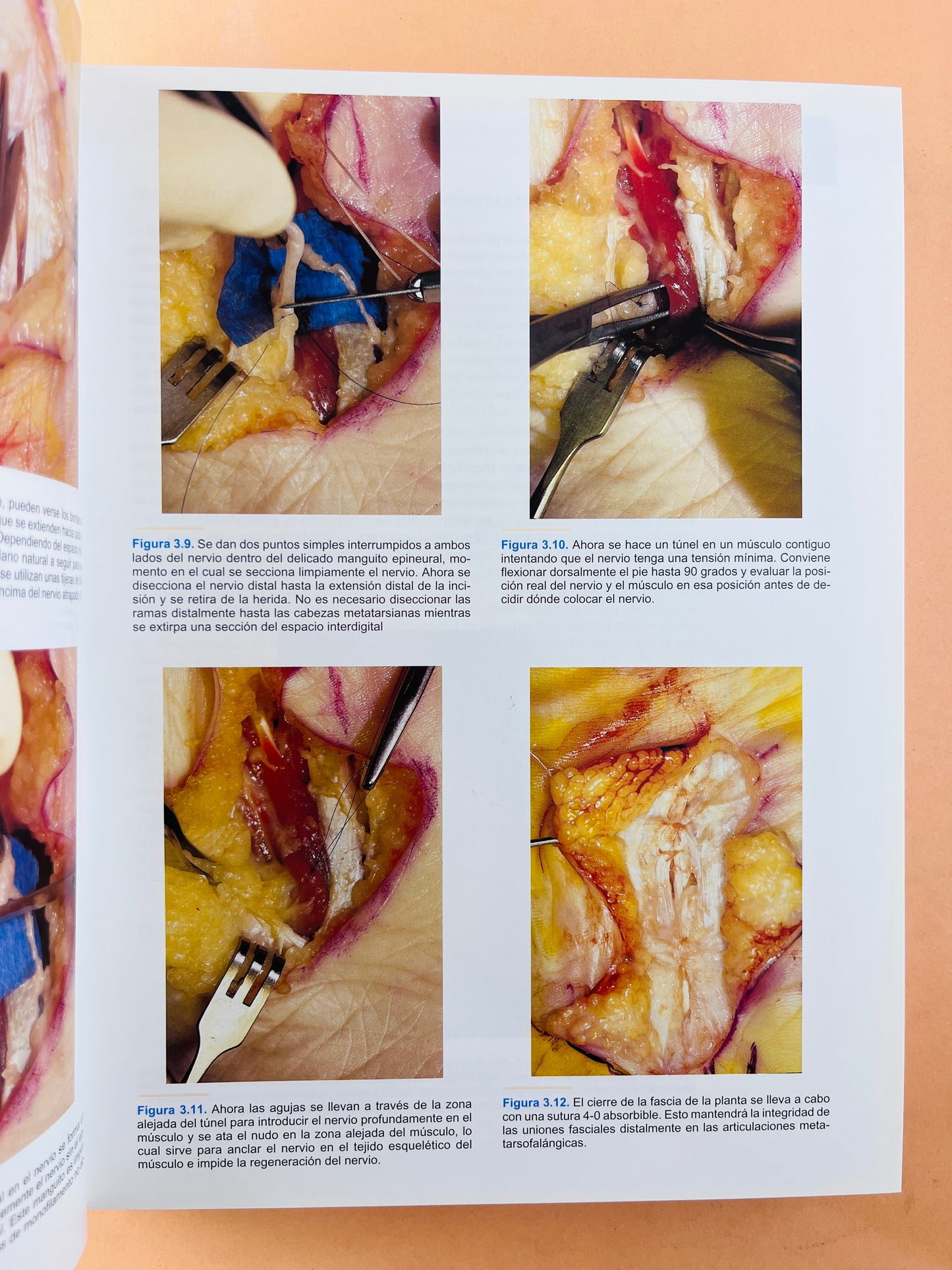 Técnicas en cirugía Ortopédica Pie y Tobillo