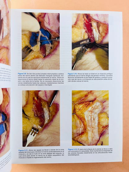 Técnicas en cirugía Ortopédica Pie y Tobillo