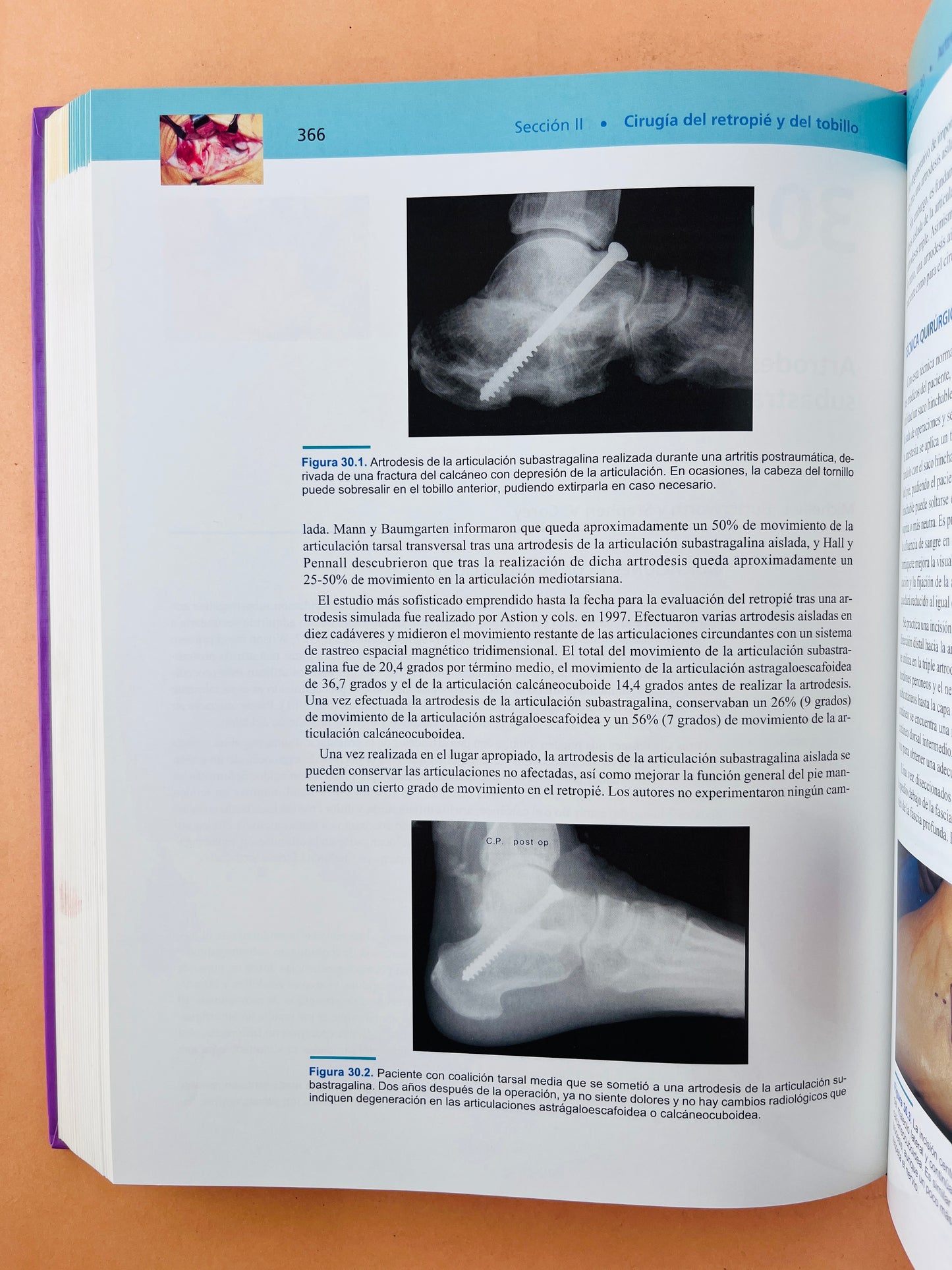 Técnicas en cirugía Ortopédica Pie y Tobillo
