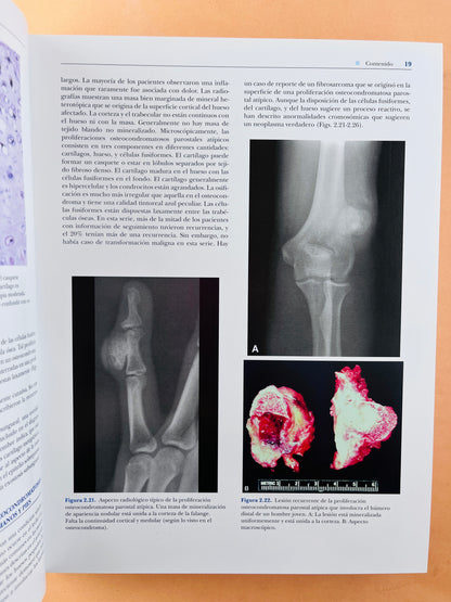 Dahlins Tumores Óseos aspectos y datos generales sobre 10165 casos sexta edición