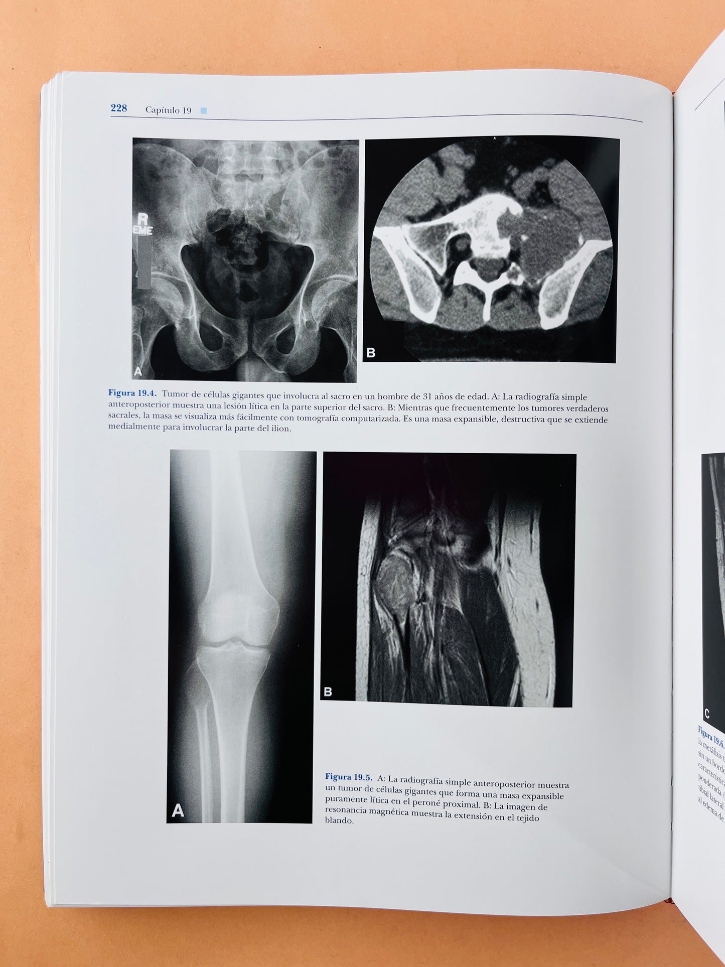 Dahlins Tumores Óseos aspectos y datos generales sobre 10165 casos sexta edición