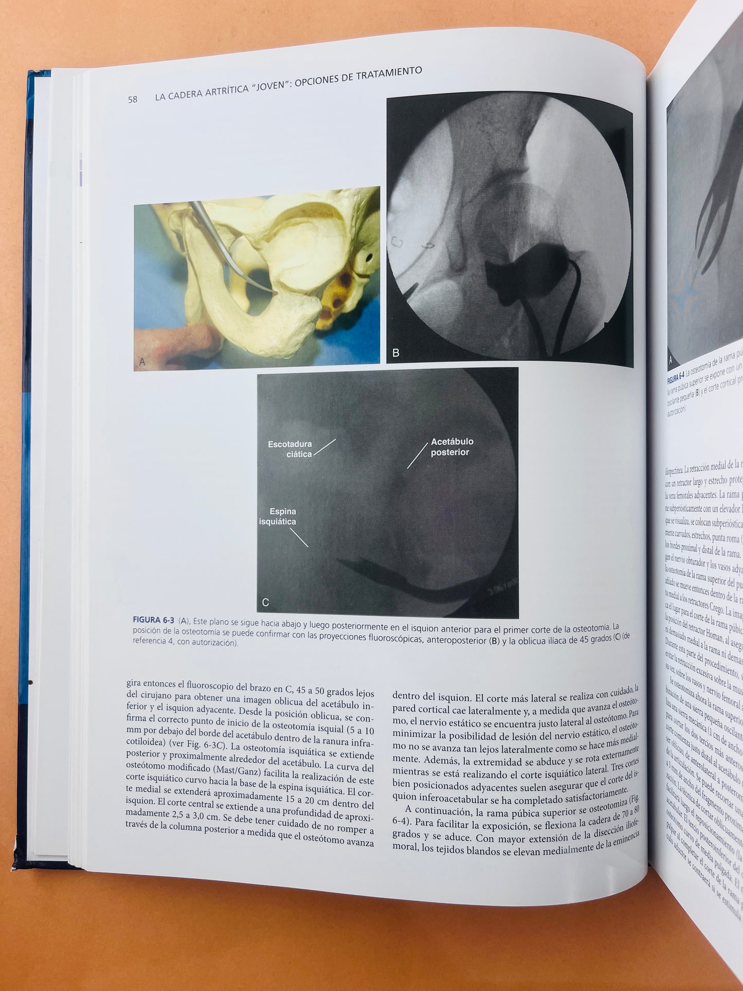Artritis y Artroplastia Cadera