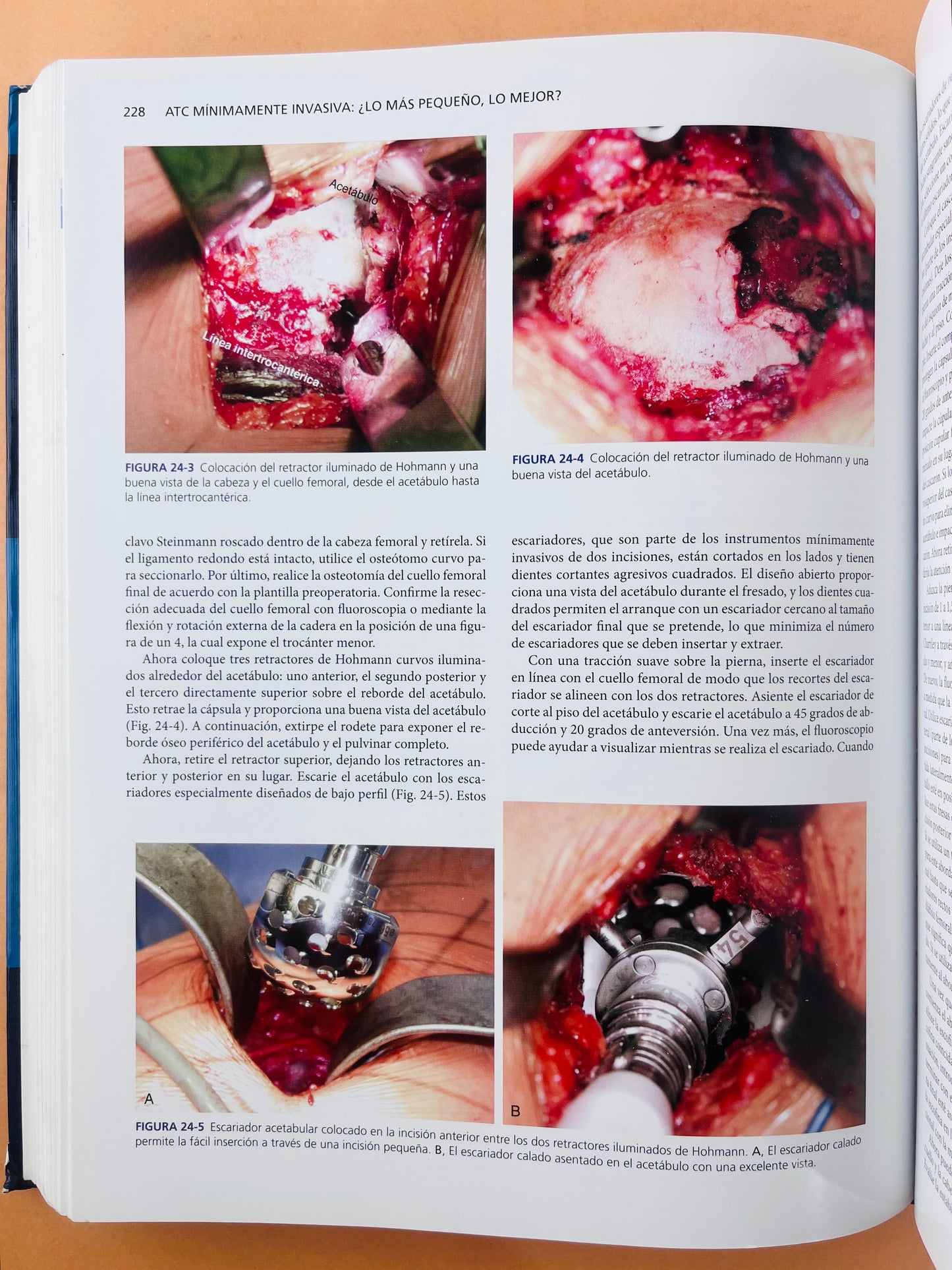 Artritis y Artroplastia Cadera