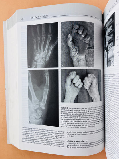 Greens Cirugía de la mano 2 volumenes