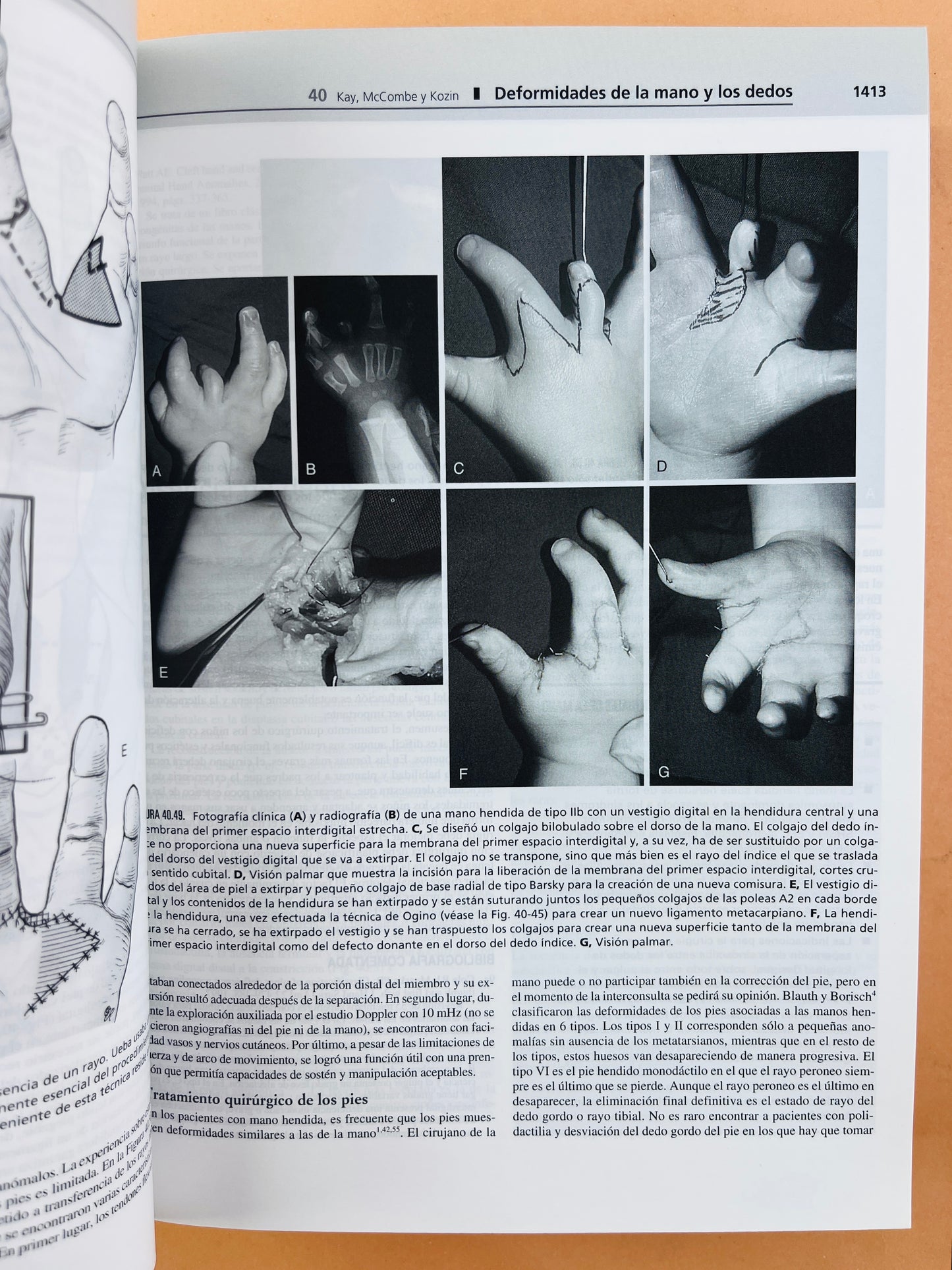 Greens Cirugía de la mano 2 volumenes