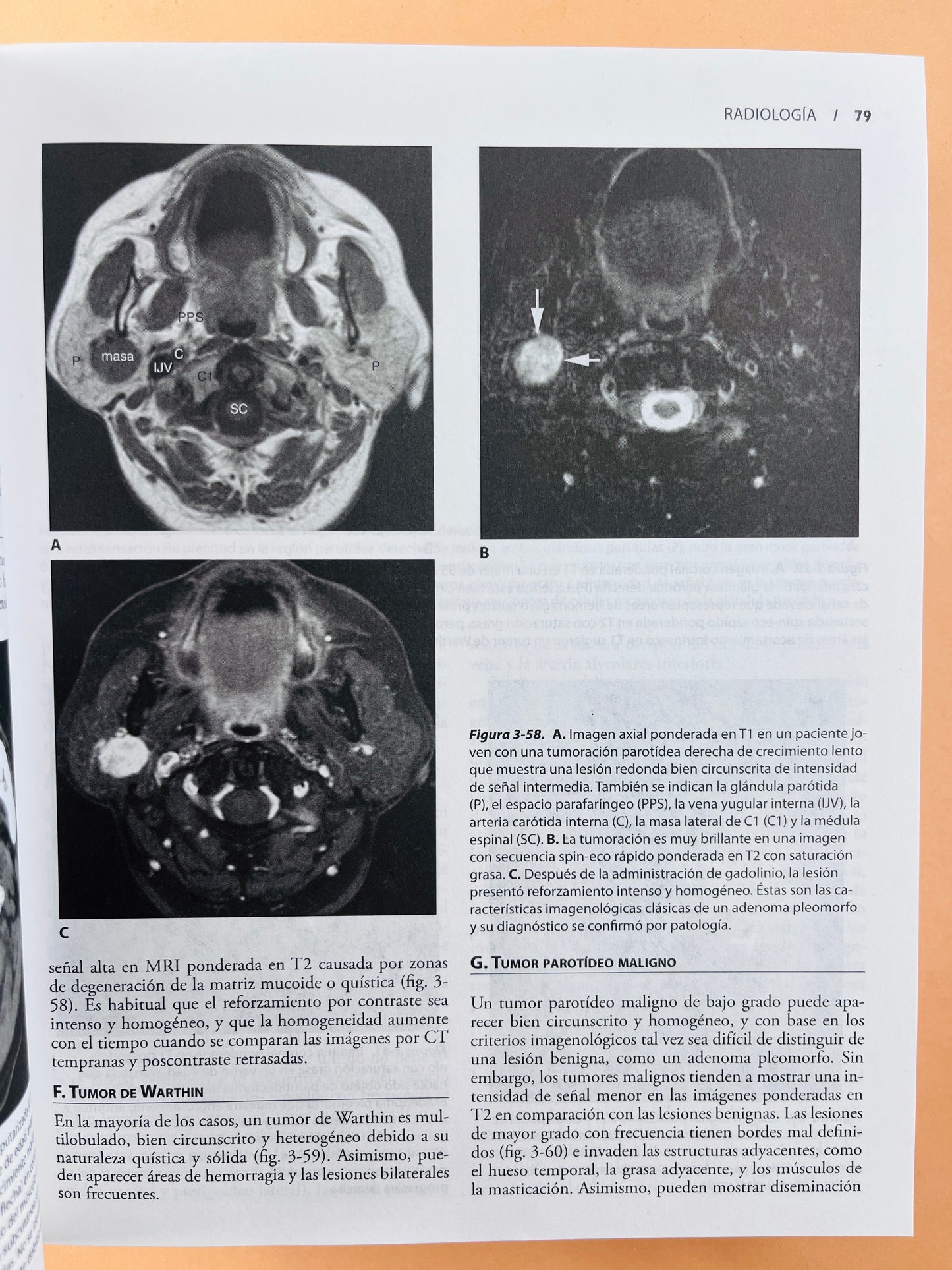 Diagnóstico y tratamiento en Otorrinolaringología cirugía de cabeza y cuello segunda edición