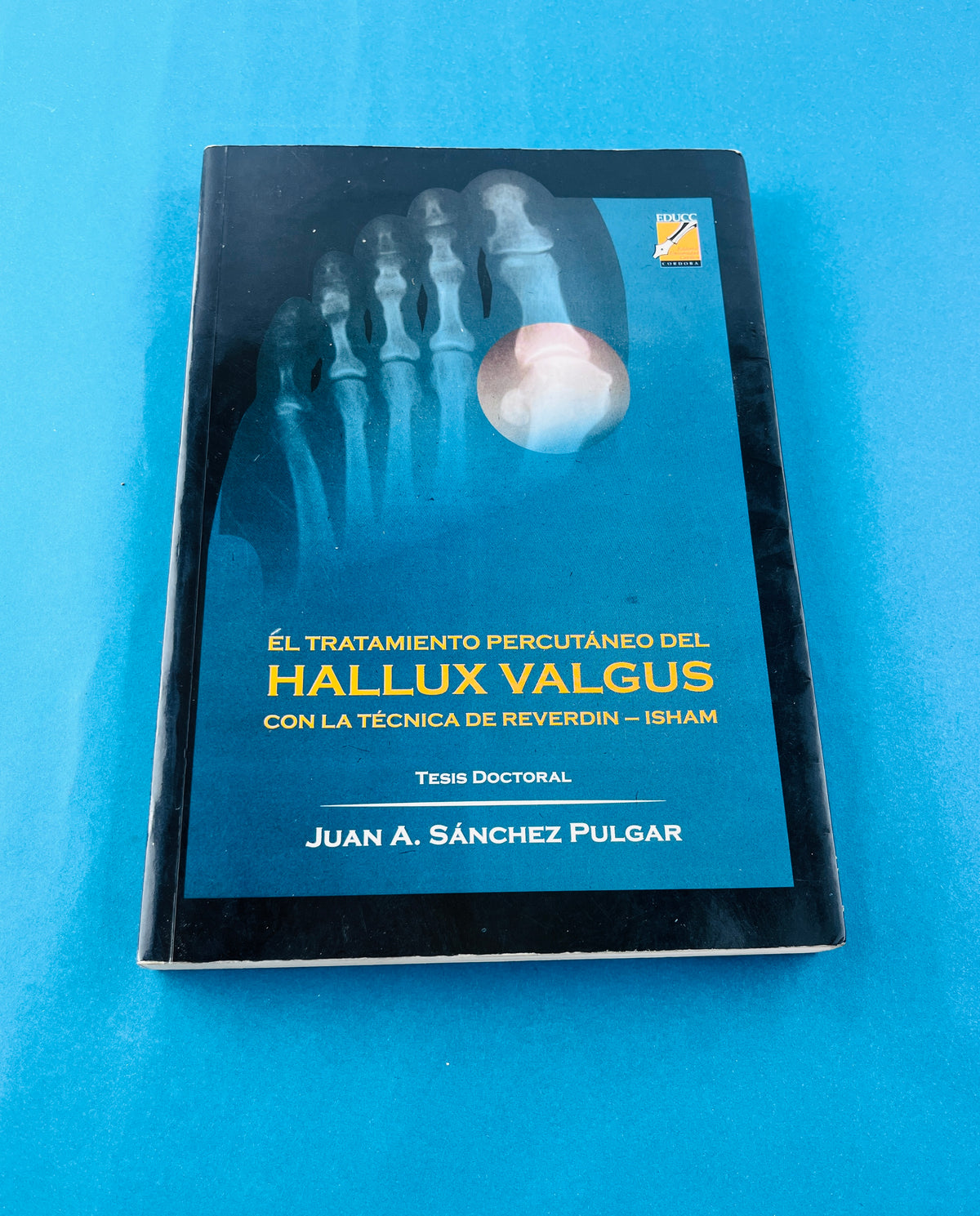 El tratamiento percutáneo del Hallux Valgus con la técnica de Reverdin Isham by Juan A. Sánchez Pulgar