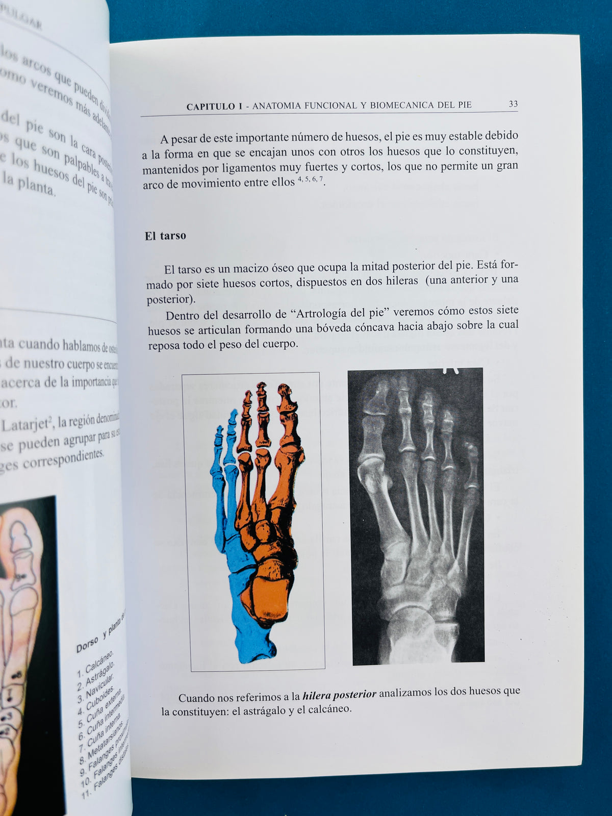 El tratamiento percutáneo del Hallux Valgus con la técnica de Reverdin Isham by Juan A. Sánchez Pulgar