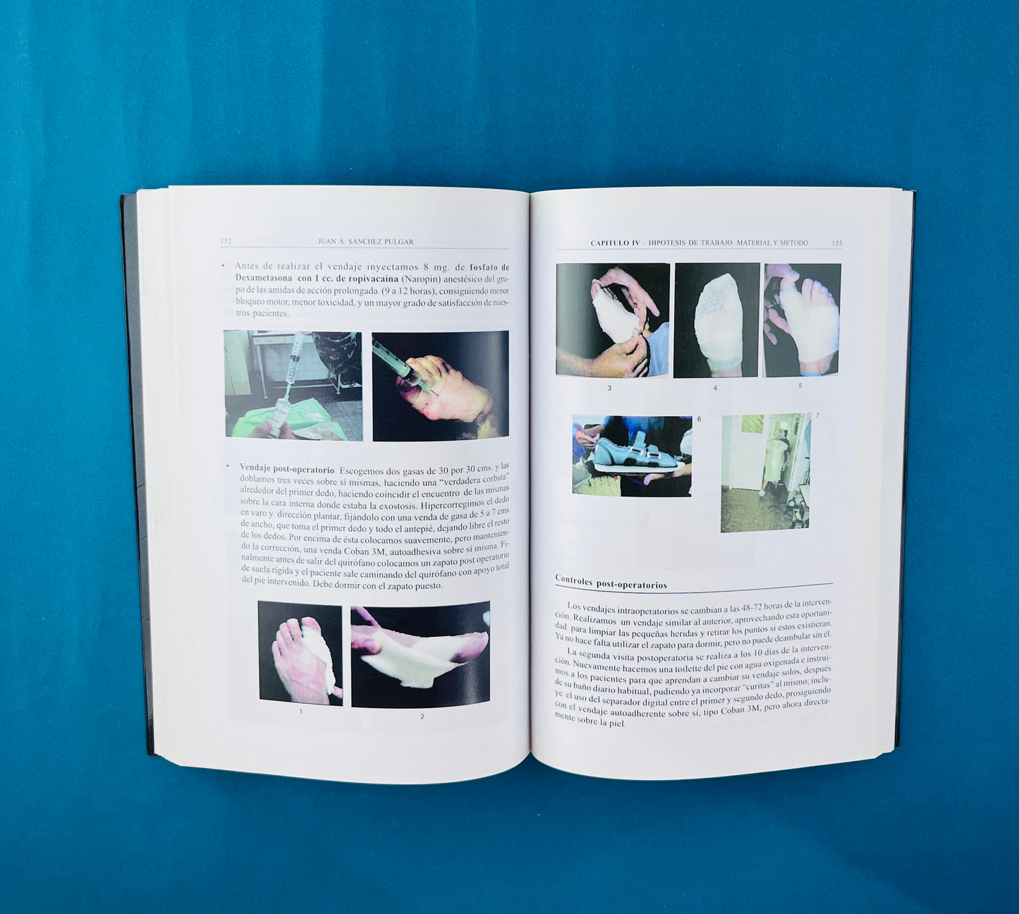 El tratamiento percutáneo del Hallux Valgus con la técnica de Reverdin Isham