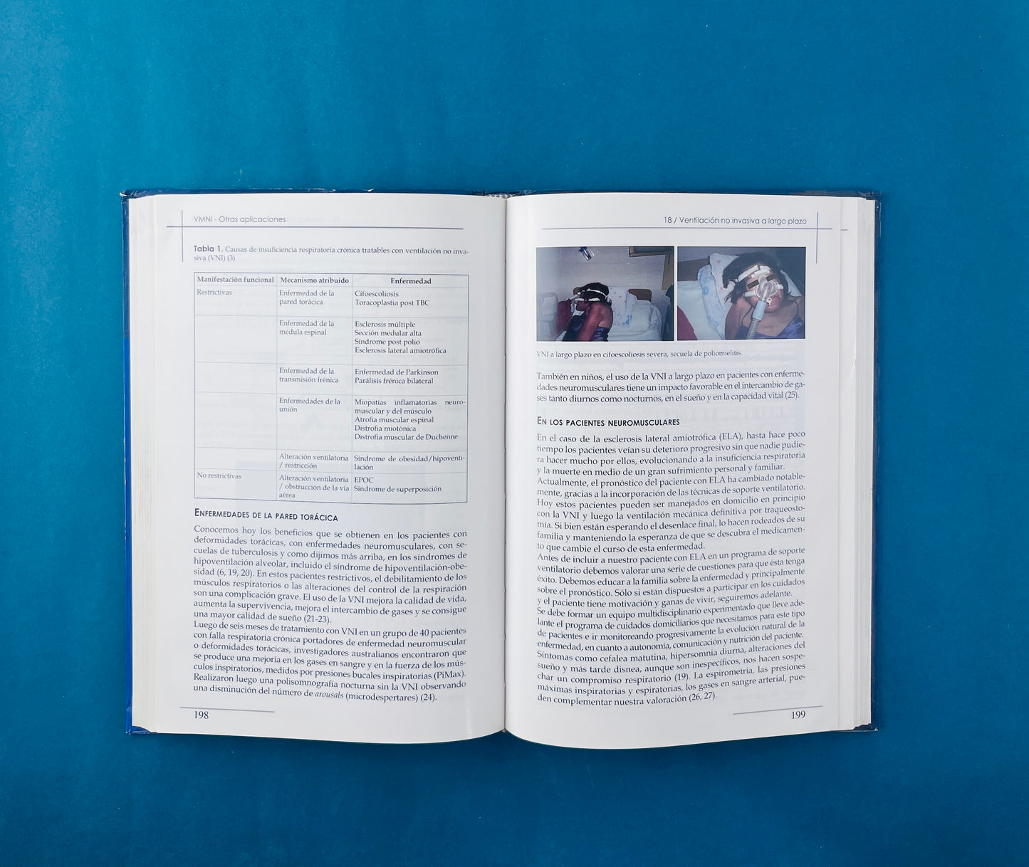 Ventilación mecánica no invasiva