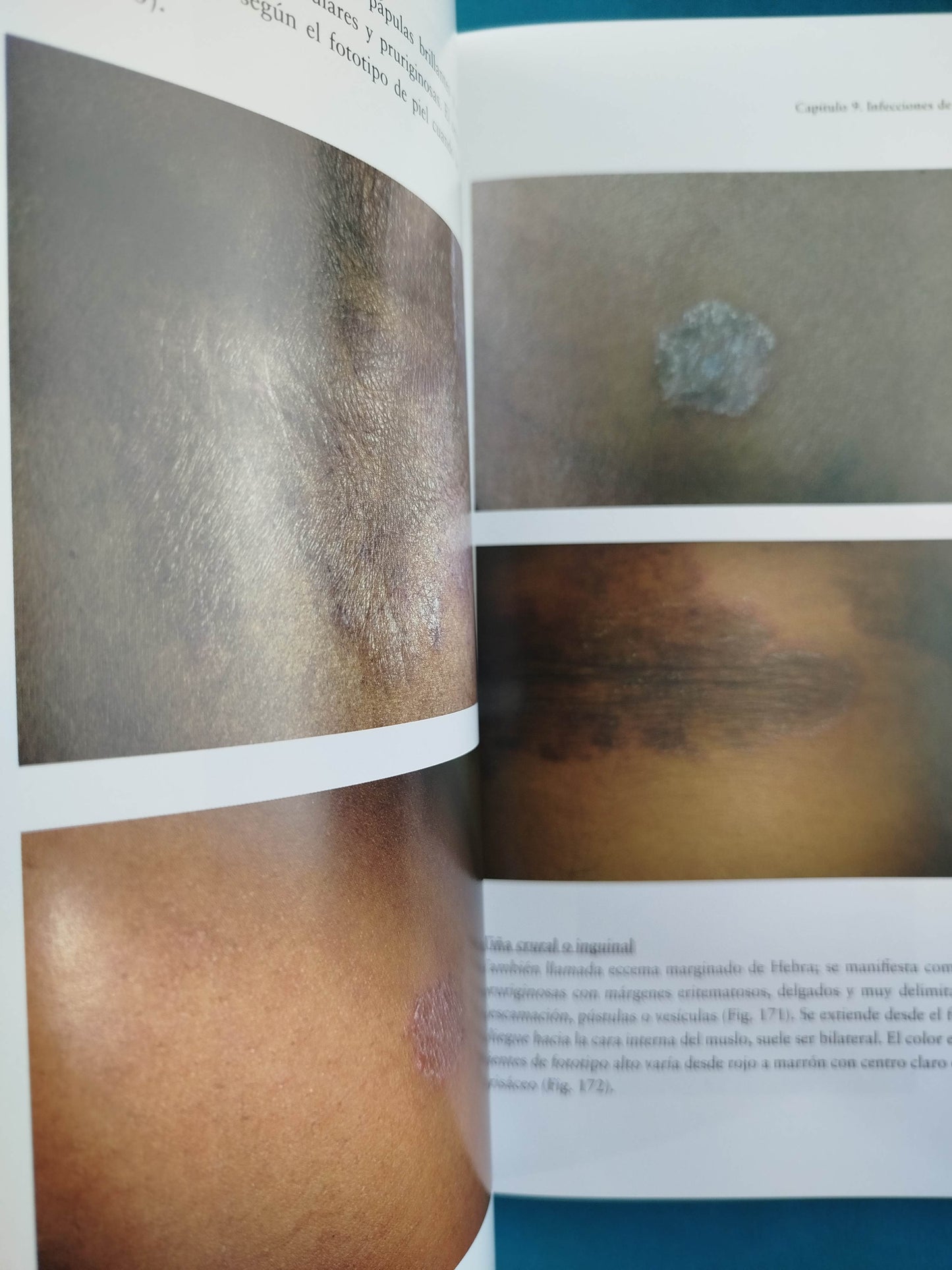 Atlas de dermatología clínica pieles oscuras