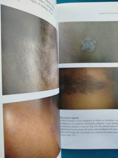 Atlas de dermatología clínica pieles oscuras